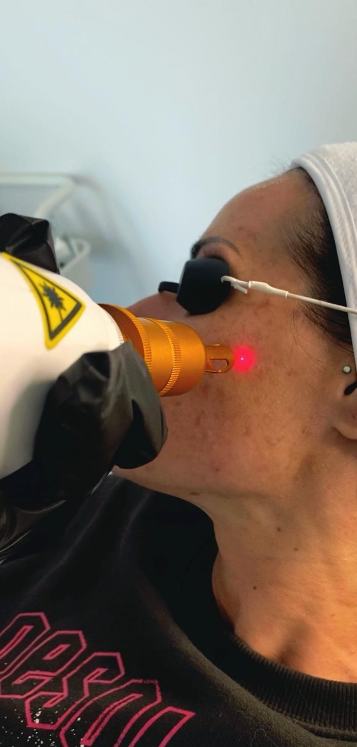 Pigmentation removal kent