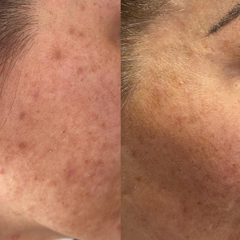 scarring removal