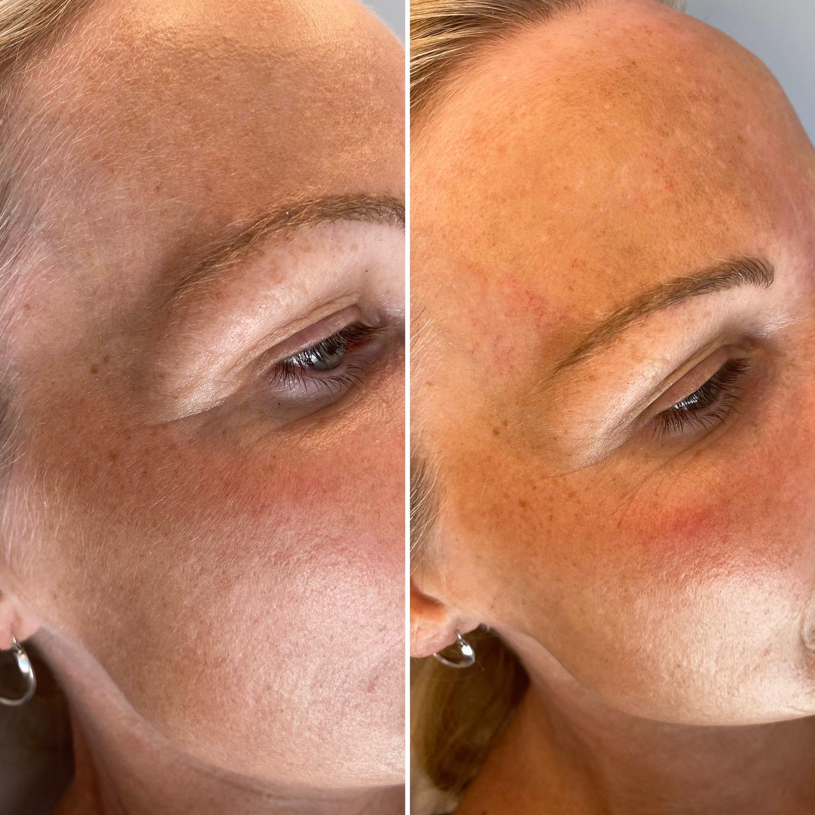 dermaplanning