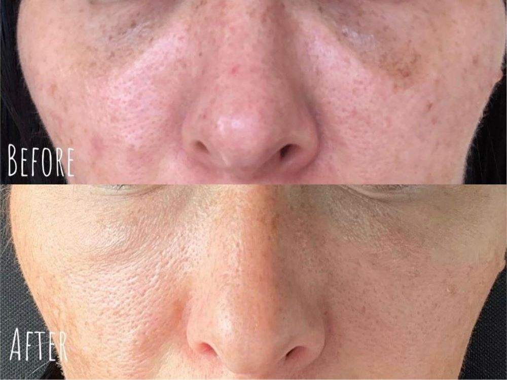 skin rejuvenation