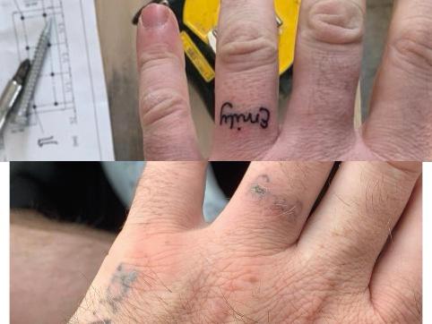 hand tattoo removal first session