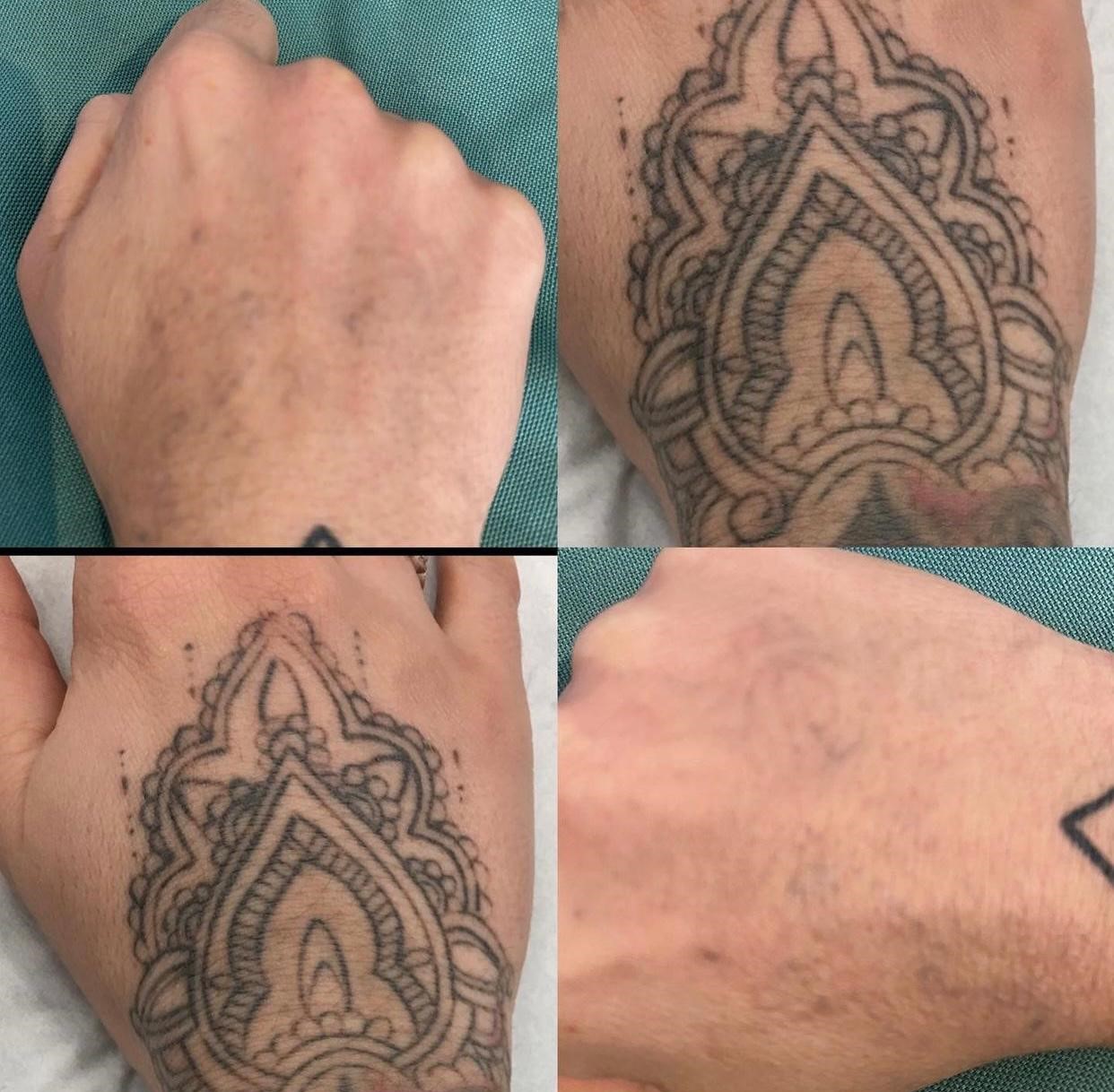 hand tattoo removal