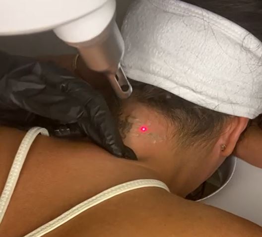 laser tat removal